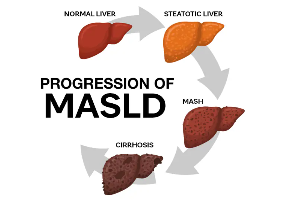 <p>MASLD (Metabolic dysfunction-associated steatotic liver disease) is where fat builds up in the liver. Lipolysis, which would usually be stopped by insulin, is not, so fat build up in the liver, slowly losing functionality of the liver</p>