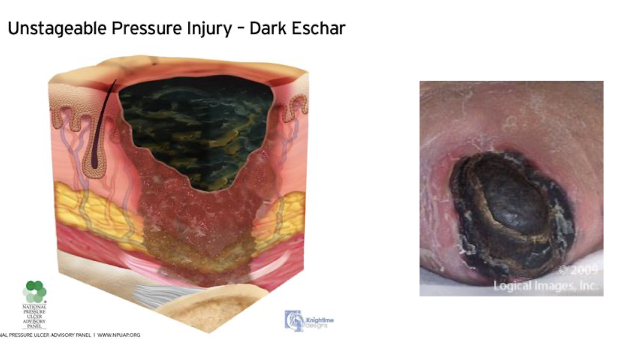 <p>Unstageable:</p><ul><li><p>What is it?</p></li><li><p>Can extent of tissue damage within the ulcer be confirmed?</p><ul><li><p>Why or Why Not?</p></li></ul></li><li><p>If Slough or Eschar is removed, what will be revealed?</p></li></ul><p></p>