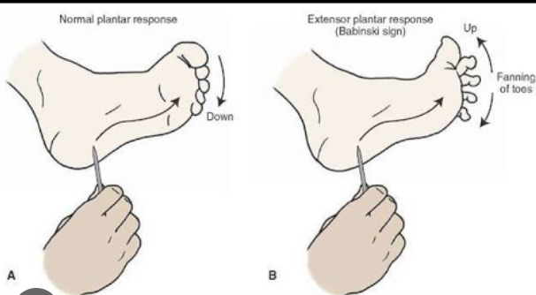 <p><strong><u>plantar flexion</u></strong></p><p>procedure:</p><ol><li><p>subject remove right shoe/sock</p></li><li><p>tester takes metal handle of mallet and runs it firmly towards the big toe</p></li></ol><p>normal response → in adults: toes flex</p><p>abnormal response → in adults: babinski sign — toes spread (normal in children under 18 months)</p>
