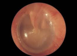 <p>The <strong><em></strong></em>__ is the membrane that separates the external ear from the middle ear and vibrates in response to sound waves.</p>