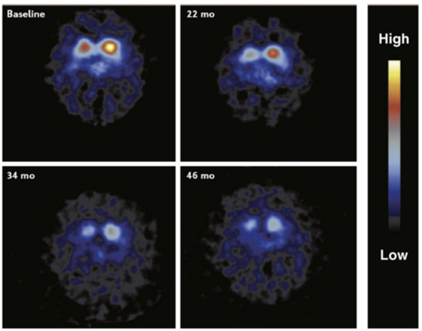 <p>-Pic is of the two striata</p><p>-We have 2 striata on each side of the brain: disease is usually worse on one side than the other</p><p>-The PET ligand is binding to the presynaptic dopamine transporter on S. Nigra (we are tracking the disappearance of S. Nigra)</p>