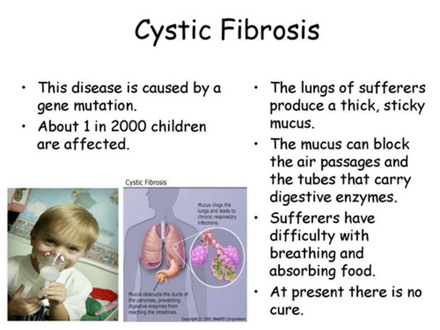 <p>Symptoms include poor growth, respiratory infections, and malabsorption due to abnormal chloride channels.</p>