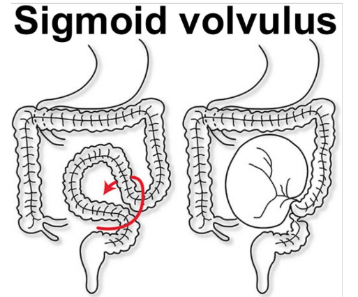 <p>has a relatively narrow mesentery → so quite mobile → prone to twisting</p>