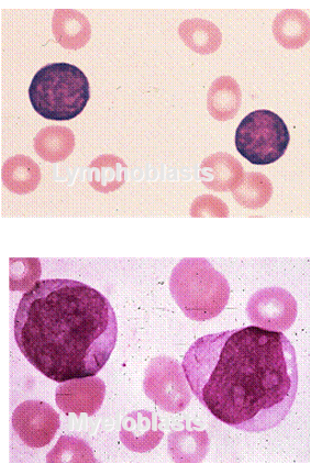 <p>ALL: coarse chromatin, inconspicuous nucleoli </p><p>AML: finer chromatin, more CP, prominent nucleoli</p>