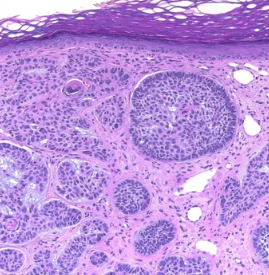 <p>Which one: <strong>Basal Cell Carcinoma</strong> OR <strong>Normal Epithelium</strong></p>