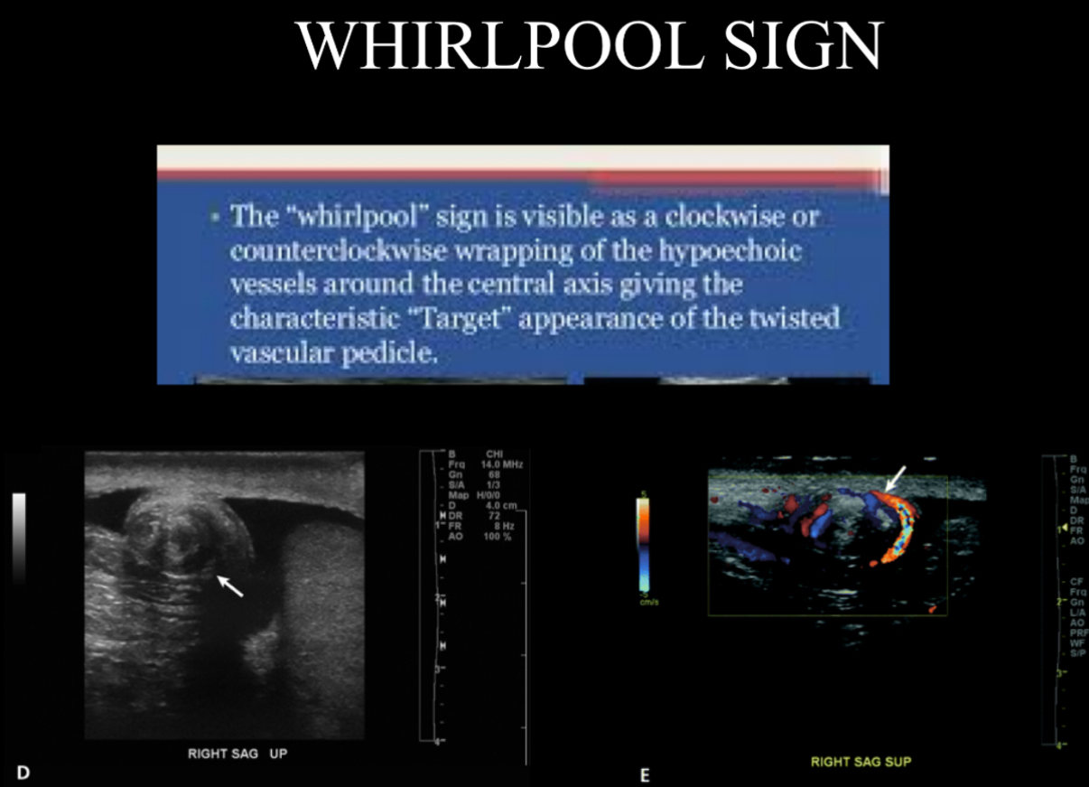 <p>The torsion knot or whirlpool sign is a sonographic indicator of what?</p>
