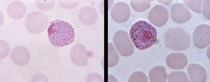<p>in human</p><p>fever, regular synchronous paroxysms</p><p>SE Asia, South America, North Africa</p>