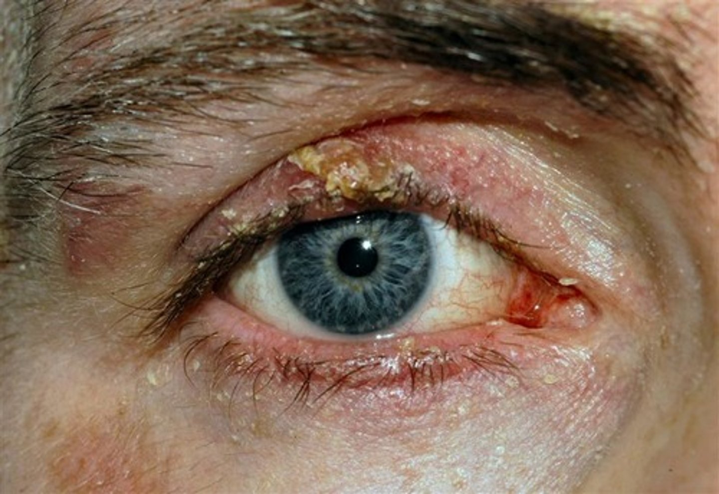 <p>Blepharitis</p>