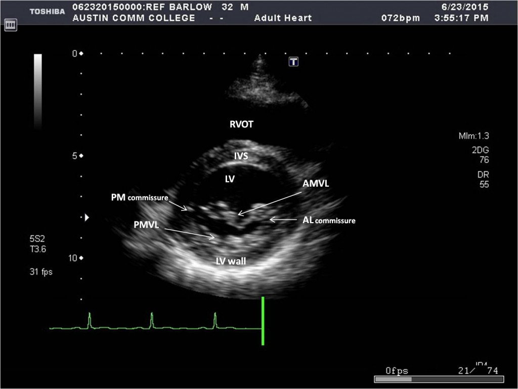 * LV
* RV
* Anterior mitral valve leaflet (AMVL)
* Posterior mitral valve leaflet (PMVL)
* IVS (interventricular spetum)
* Inferior LV wall