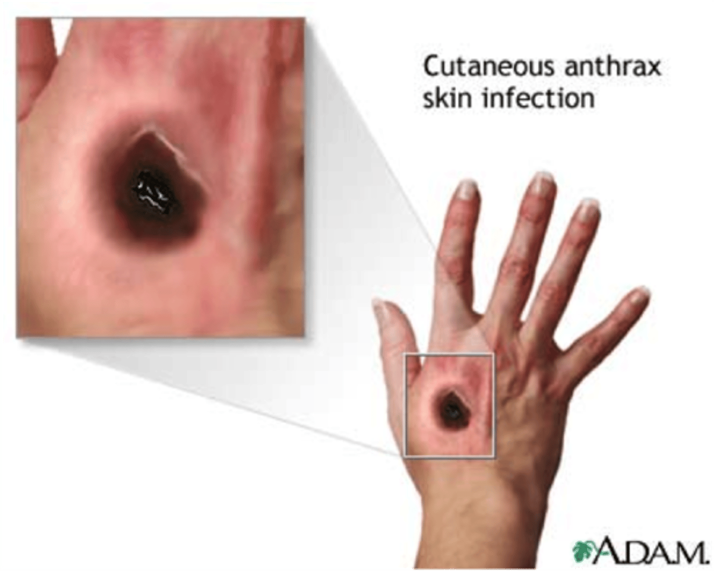 <p>skin lesions from handling animal skins.</p><p>not typically deadly</p>