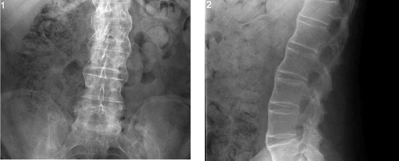 <p>form of spondyloarthritis; bamboo appearing spine caused by calcifications bridging over the disk spaces</p><p>may cause eventual fusion of the spine</p>