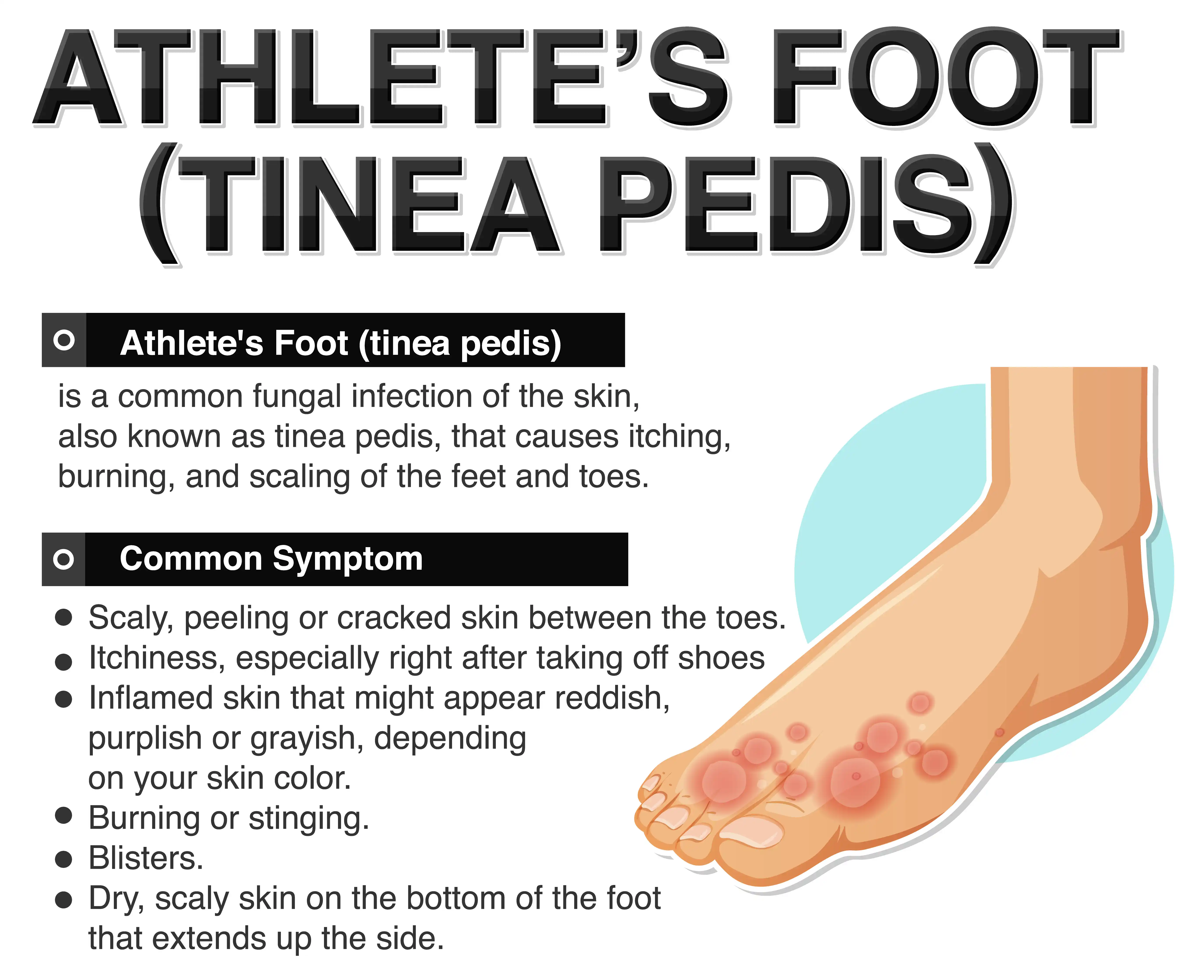 <p>PP: fungal infection of feet</p><p>E: dermatophytes</p><p>CM: macerated scale on feet</p><p>DX: KOH<br>bx culture<br>biopsy (rare)</p><p>TX:<br>NP: wear protective footwear in communal areas<br>minimize foot moisture</p><p>MX: topical antifungals<br>mocacsin-type/chronic→PO antifungals</p>