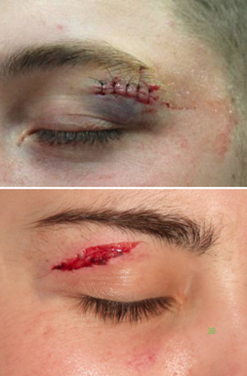 <p>laceration or abrasion to skin</p>