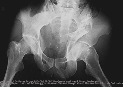 <p>The impacted hemipelvis is forced inward, folding or buckling the ilium.</p>