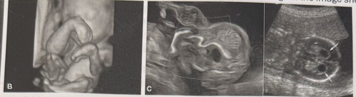 <p><span>What is the most likely diagnosis based on the sonographic findings in the image shown?</span></p><ol><li><p><span>﻿﻿﻿Trisomy 21</span></p></li><li><p><span>﻿﻿﻿Trisomy 18</span></p></li><li><p><span>﻿﻿﻿Trisomy 13</span></p></li><li><p><span>﻿﻿﻿Turner syndrome</span></p></li></ol>