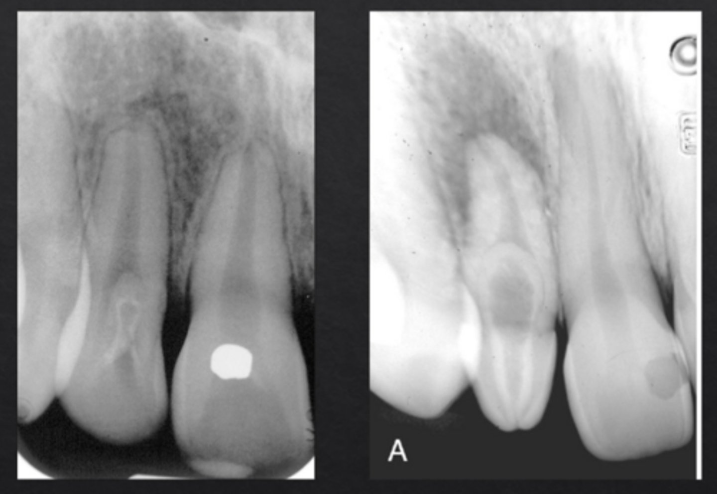 <p>Infolding of enamel into the tooth, forming "tooth within a tooth"</p>