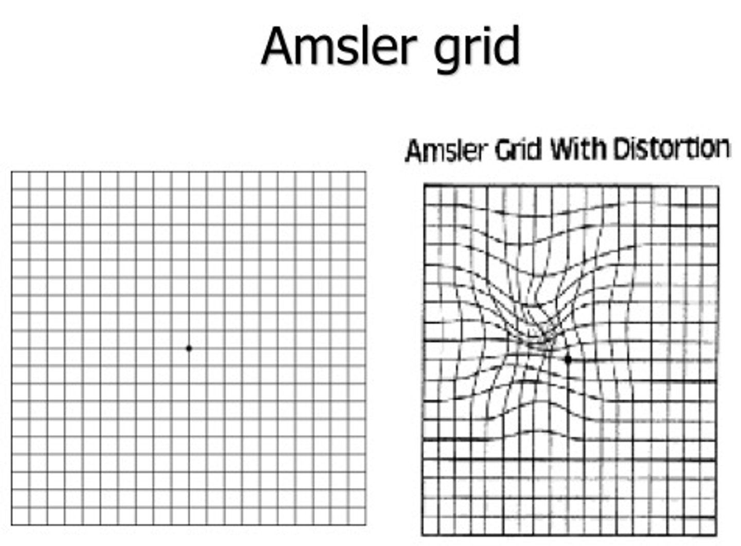 <p>test to assess central vision and to assist in the diagnosis of age-related macular degeneration<br>-monocular<br>-ask pt if any squares within the grid are missing or blurred or if the lines are appear wavy or distorted<br>-record findings on recording sheet; patient can draw what they see</p>