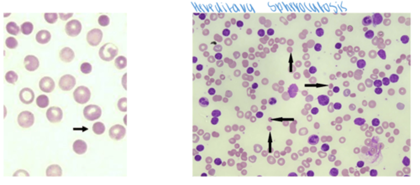 <p>*lack of central pallor</p><p>increase MCHC</p>