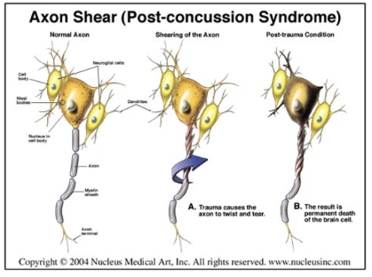 <p>Axon shearing is a type of injury characterized by the tearing of axons in the nervous system, commonly associated with traumatic brain injuries such as concussions or blunt force trauma. This injury disrupts communication between neurons and can lead to significant functional impairments. </p>