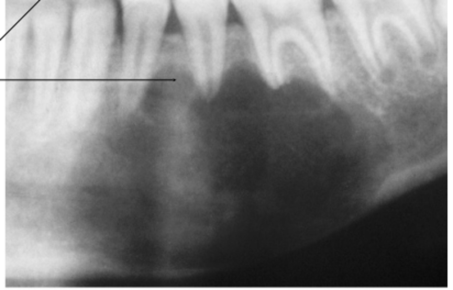 <p>Where does simple bone cysts typically occour?</p>