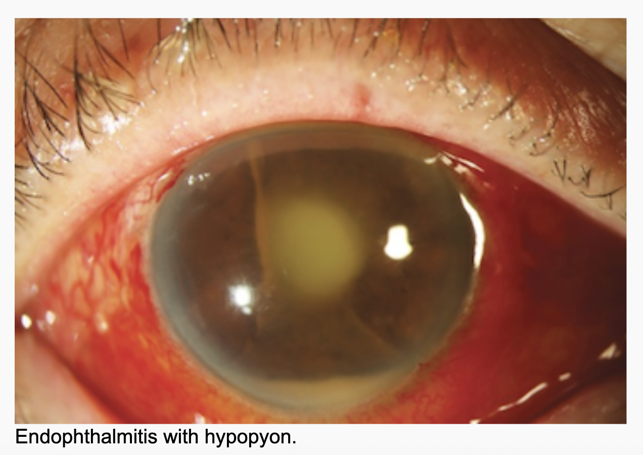 <p>Endophalthmitis</p>