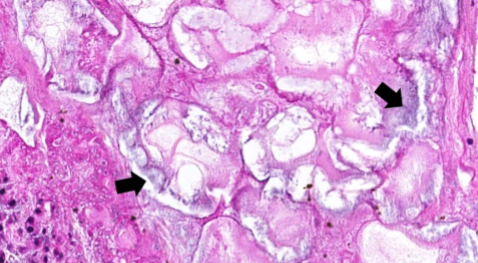 <p>What kind of necrosis is this</p>