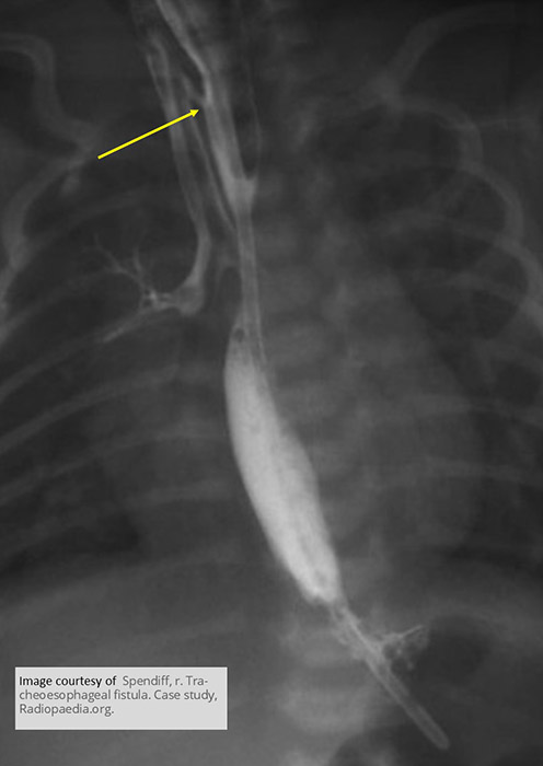 <p>What contrast should be used if fluoroscopy is required for TEF?</p>