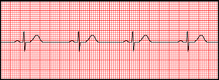 <p>Bradycardia</p>