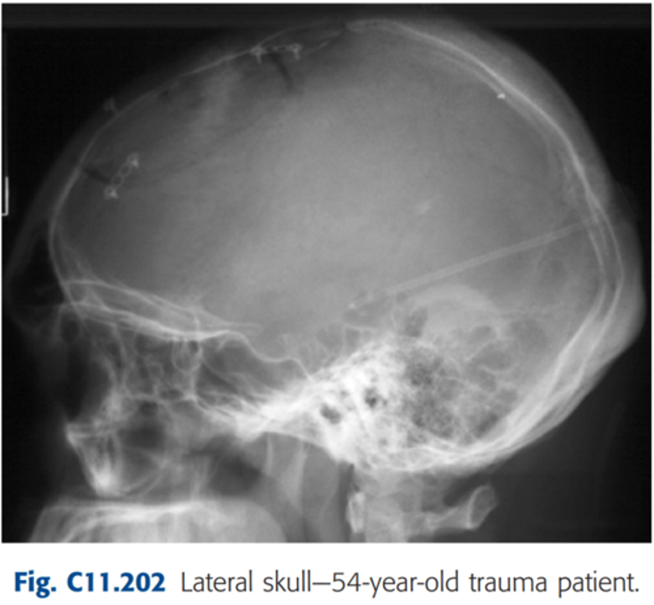 <p>Repeatable errors (four)—</p><p>Criterion 1: Anatomy demonstrated: The vertex (region of skull trauma) and posterior aspect of the skull appears to be just slightly cut off (region of skull trauma). </p><p>Criterion 2: Positioning: The skull is tilted and rotated. (Note the separation of the orbital plates from the tilt and separation of the greater wings of the sphenoid, the rami of the mandible, and the EAMs, indicating rotation and tilt). </p><p>Criterion 3: Collimation and CR: CR centered too anterior to skull. </p><p>Criterion 5: Anatomic side markers: Anatomic side marker is partially demonstrated.</p>