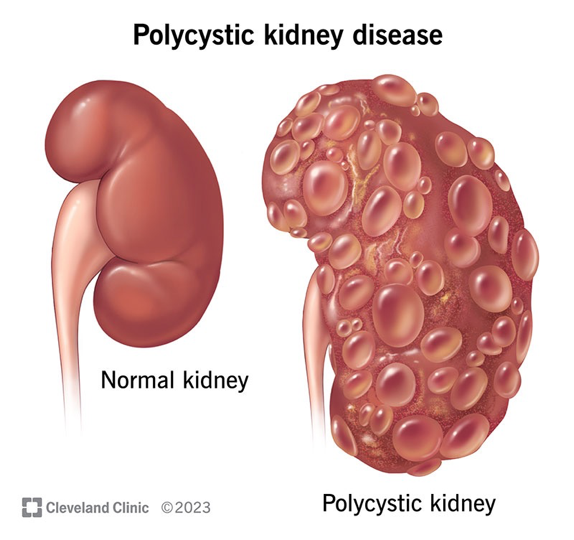 <p>Polycystic Kidney Disease (PKD)</p>