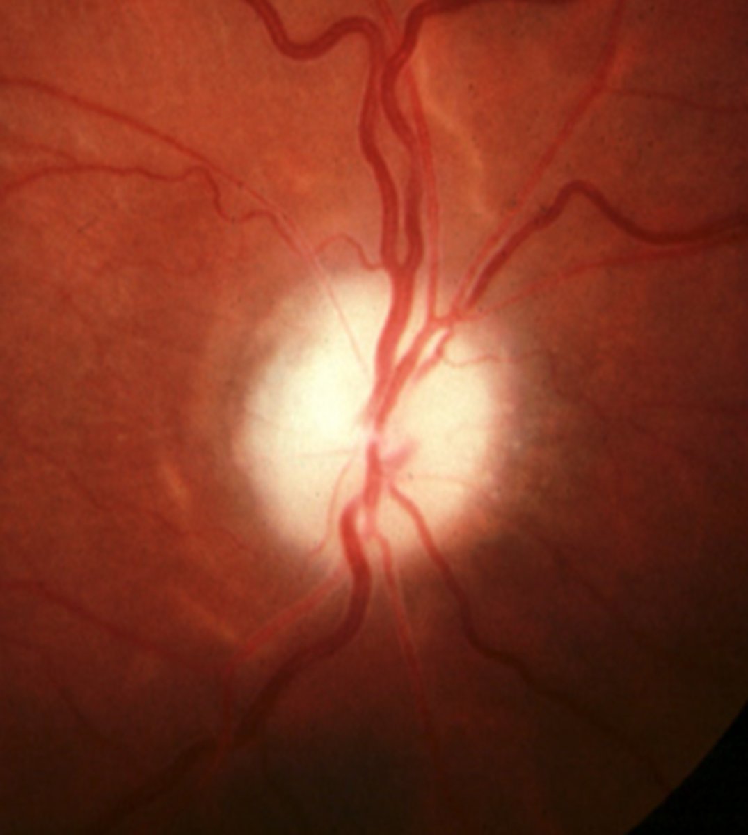 <p>AKA secondary optic atrophy = lesion in the ganglion cells or ONH or due to RP = BLURRY disc margins, artery attenuation or absence, sheathed BV</p>