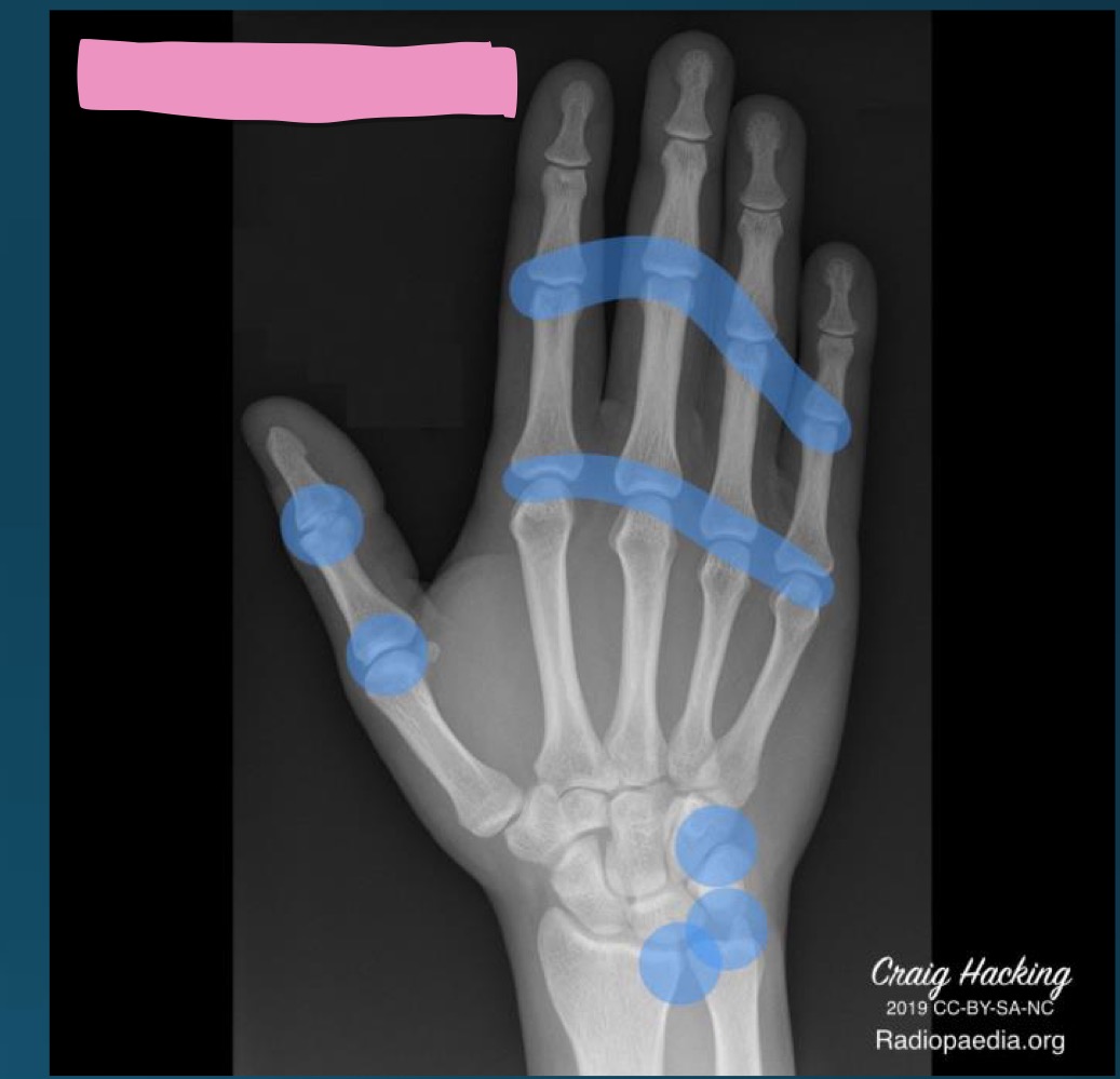 <p>what diagnosis is this distribution describing </p>
