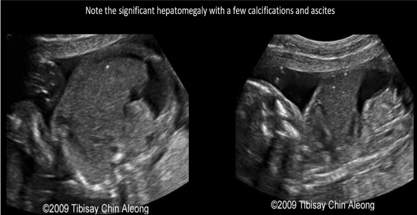 <p>fetal measurements from 23w GA exam </p><ul><li><p>HC 23w2d</p></li><li><p>BPD 23w </p></li><li><p>AC 26w1d</p></li><li><p>FL 23w5d</p></li></ul><p>what would be the most likely cause </p><p>a) macrosomia</p><p>b) maternal syphillis</p><p>c) hydrops</p><p>d) head sparing w/asymmetric IUGR</p>