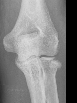 <p>Game plan for radial head fracture</p>