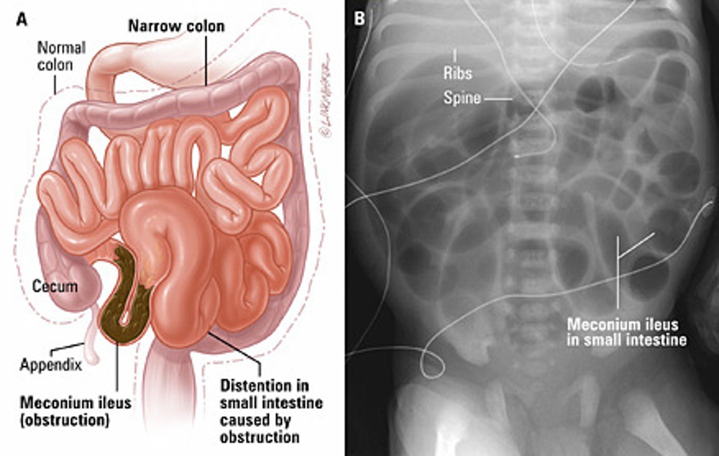 <p>small-bowel disorder marked by the presence of thick echogenic meconium in the distal ileum. Essentially diagnostic of CF in the neonatal period</p>