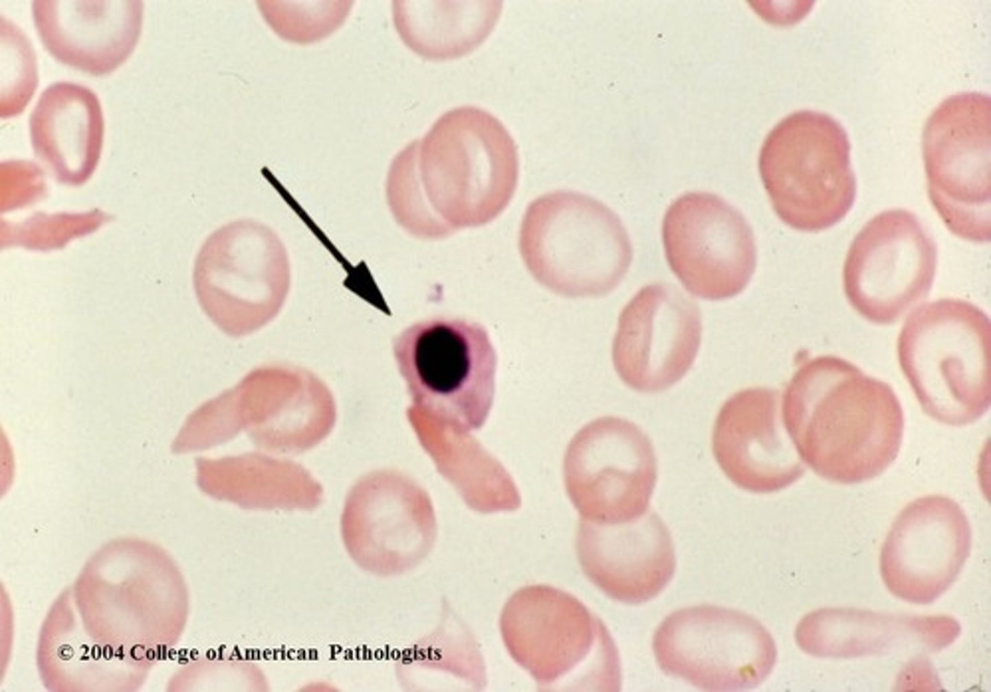 <p>An immature stage of the erythrocyte that still has a nucleus. Normally not found in the peripheral blood of a healthy adult.</p>