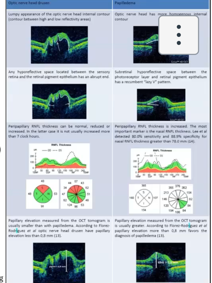 <p>drusen is lumpy calcium/proteins deposits in onh </p><p>canmake onh margins appear indistiny and mimic papilloedema </p><p>hard to distinguish  even with oct if rnfl thickness is increased </p>