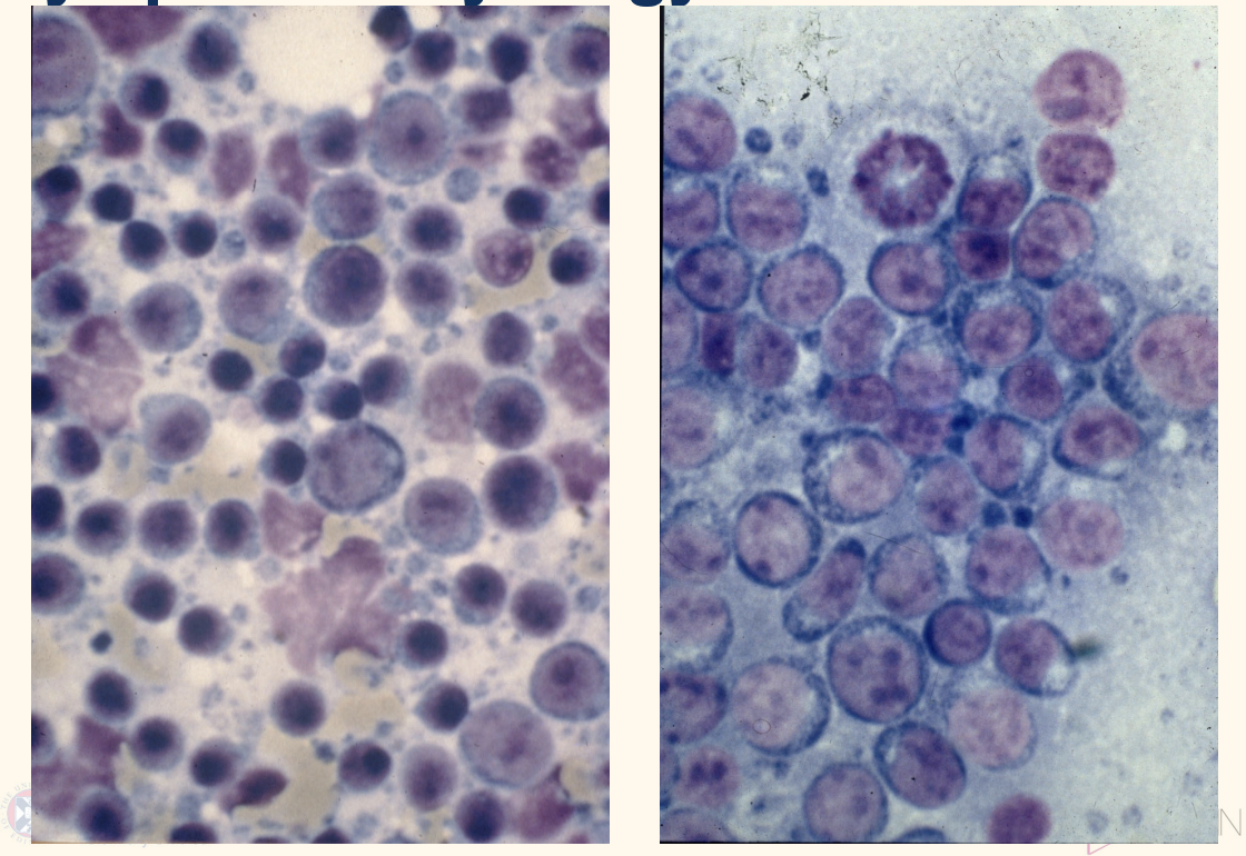 <p>lymphoma on R, </p><p><span style="font-size: calc(var(--scale-factor)*12.00px)"> high-grade lymphoma </span></p><ul><li><p><span style="font-size: calc(var(--scale-factor)*12.00px)">monomorphic population of large lymphoblasts (&gt;50%).</span></p></li><li><p><span style="font-size: calc(var(--scale-factor)*12.00px)">nuclei with clumped chromatin, multiple, pleomorphic</span></p></li><li><p><span style="font-size: calc(var(--scale-factor)*12.00px)">basophillic cytoplasm than normal small lymphocyte</span></p></li><li><p><span style="font-size: calc(var(--scale-factor)*12.00px)">Mitotic figure</span></p></li></ul><p></p>