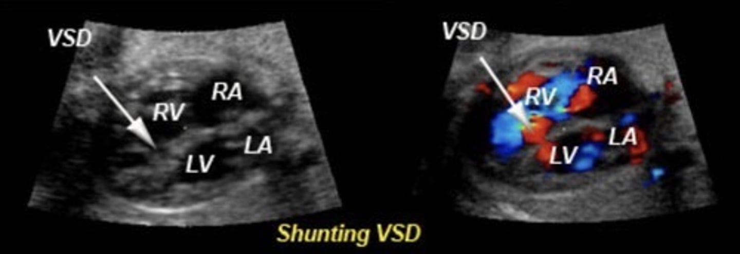 <p>Most common cardiac defect</p><p>Best seen in LVOT view or 4ch. if septum is perpendicular to sound beam</p><p>Hole in ventricular septum</p><p>Commonly in membranous septum</p>