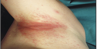 <p>Dermatitis caused by physical contact with an allergen or irritant like deodorant, soap, makeup, or urine.</p>