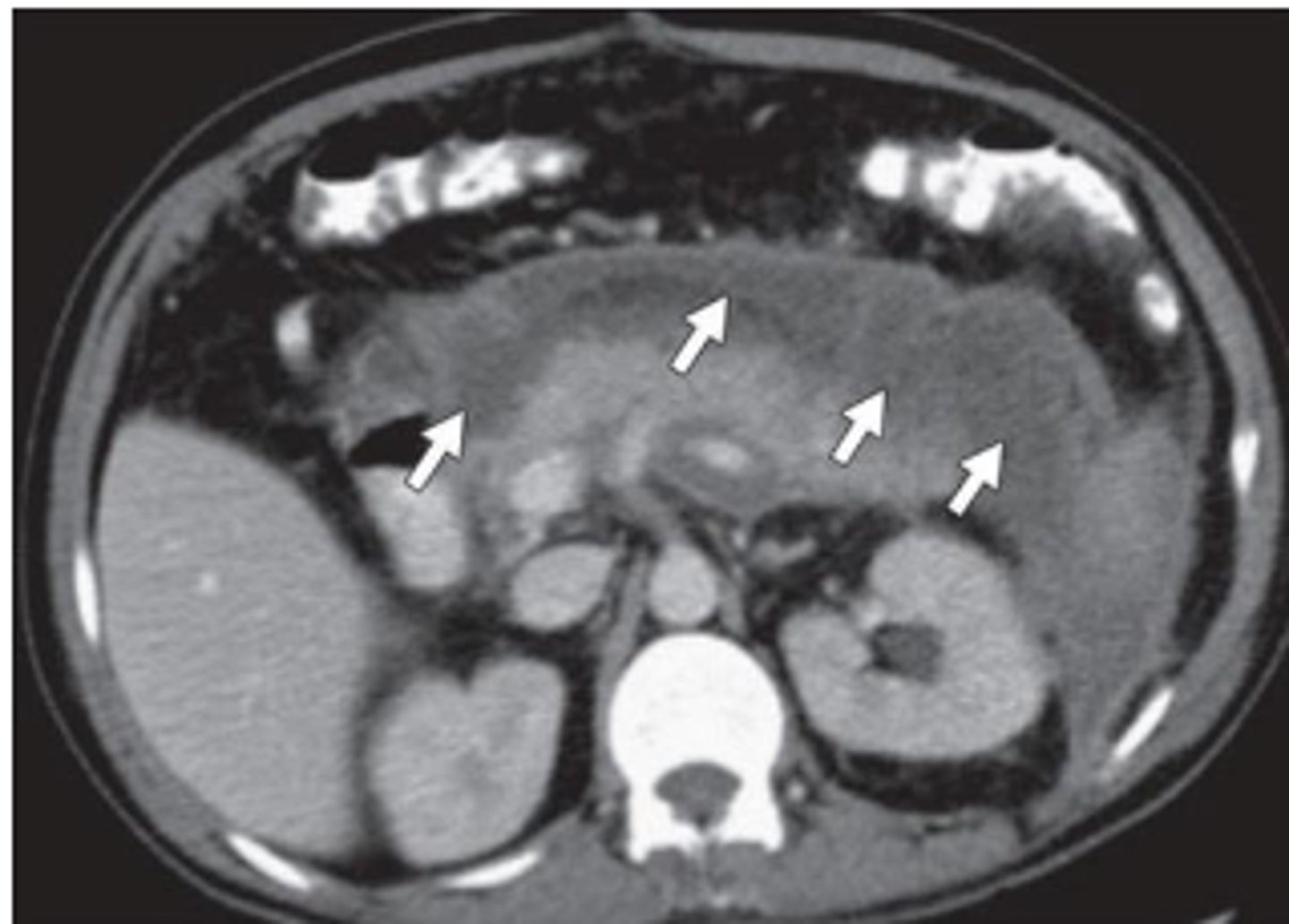 <p>inflammation of pancreas, often related to biliary tract disease or alcohol intake</p><p>Sx: abrupt onset deep epigastric pain w/ radiation to back, N/V, sweating, weakness, abdominal tenderness and distention, fever</p><p>Labs: leukocytosis, increased serum amylase, increased serum lipase</p>