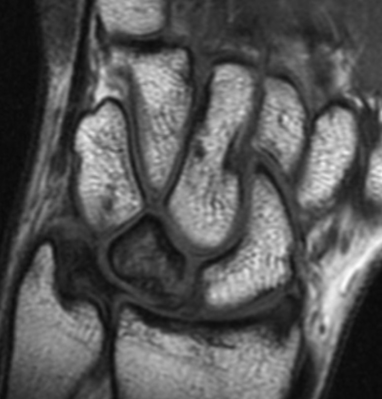 <p>Describe the pathology indicated by the arrow (Cor T1). </p>
