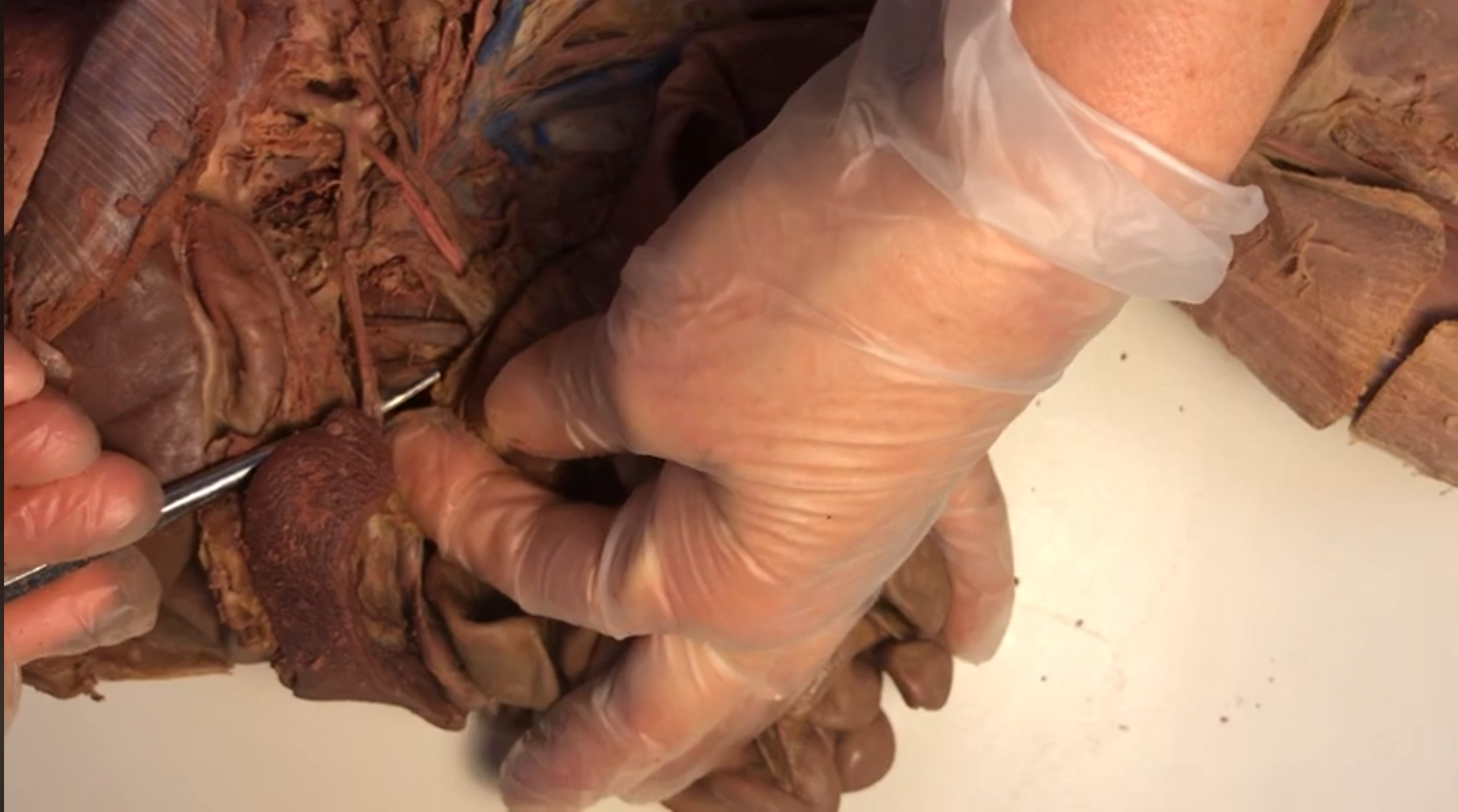 <p>What artery is this</p>