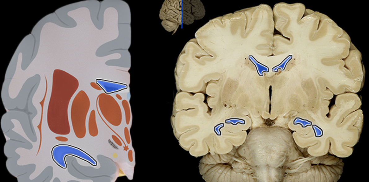 <p>Lateral ventricle</p>