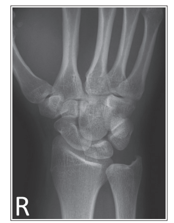 <p>What is wrong with this oblique wrist xray </p>