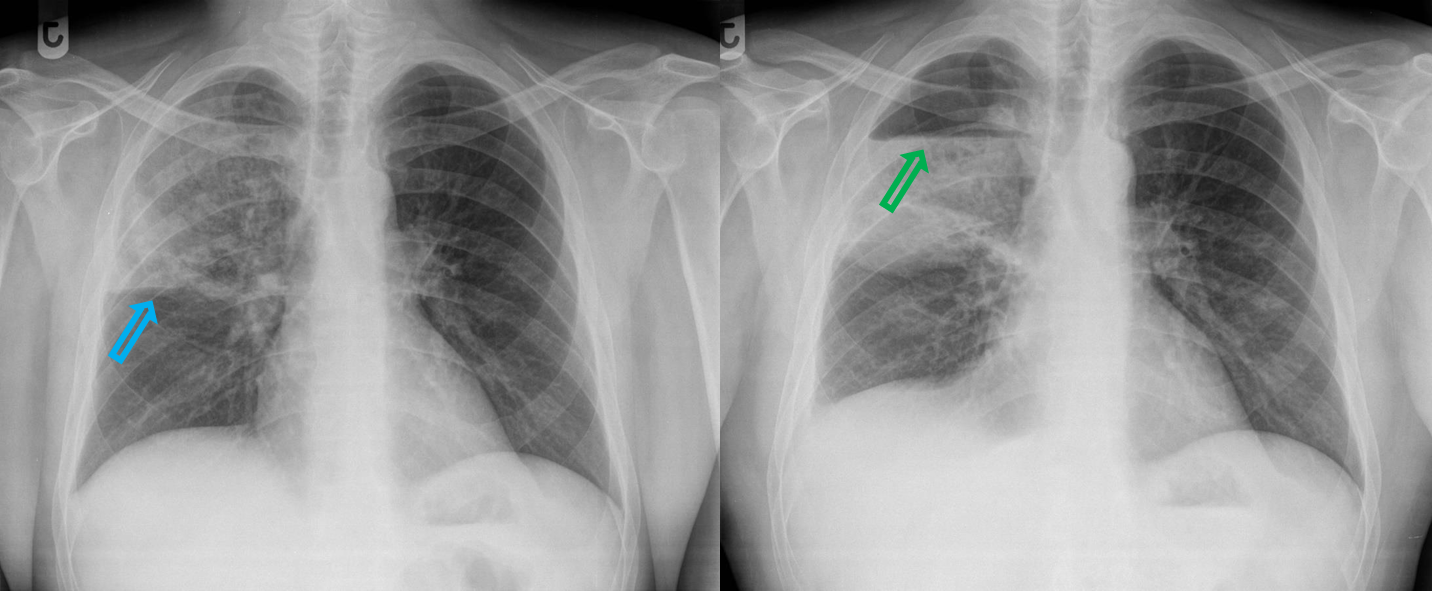 <p>Patient history: chills, chest pain and cough with purulent sputum in an immunocompromised patient</p><p>Modality : PA chest radiograph </p><p> Region : chest, lungs </p><p>Radiologic sign : left - right-sided upper lobar consolidation right - abscess with air-fluid level two weeks later (blue arrow – horizontal fissure; green arrow – air-fluid level) </p><p>Diagnosis: lobar pneumonia in the right upper lobe, which later develops an abscess</p>