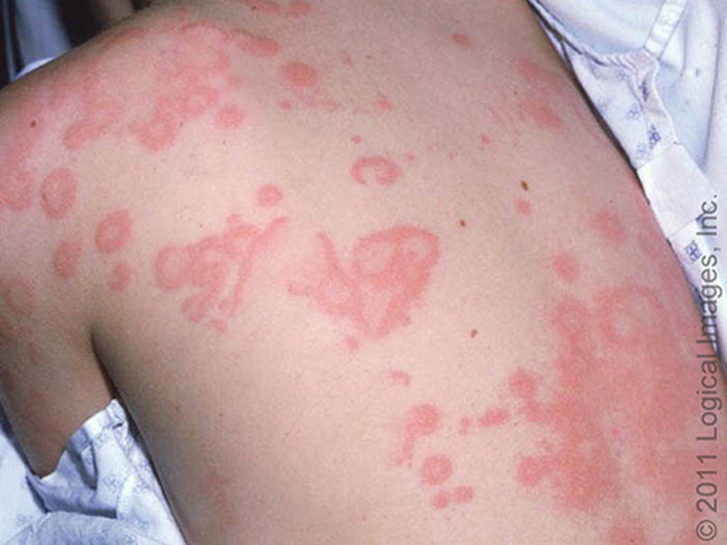 <p>raised, red blotches associated with allergic and anaphylactic reactions</p>