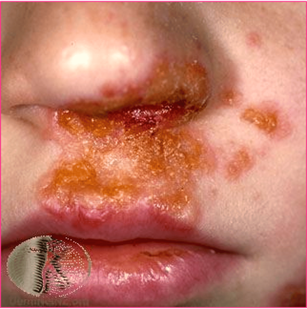<p>Ans: (D)</p><p>Bullous impetigo is an infectious bacterial disease caused by streptococci or staphylococci. The infection usually starts on the face as a single raised papule that becomes bullous and drains with pus. Within days, the lesion can spread to involve the neck, chest and arms. When the bullae are ruptured, they dry and crust over giving an appearance of honey-colored crusts.</p>