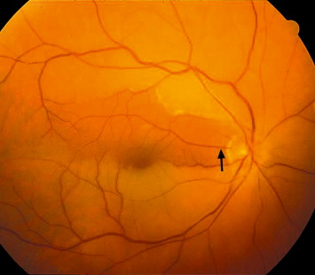 What is the function of the cilio-retinal artery?
