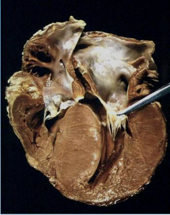 <p>Hypertrophic Cardiomyopathy</p>